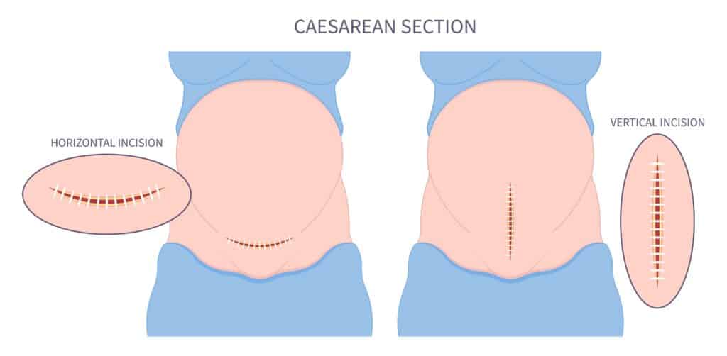 Everything You Need To Know About The C section Procedure