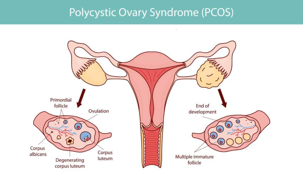 Emma Chamberlain opens up about learning of her PCOS at a hair salon | "Turns out she was an OBGYN and she diagnosed me with PCOS." Pregnancy News what is pcos